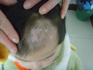 白癜风图片 白癜风图片