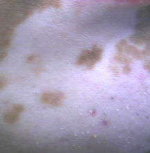 白癜风图片 白癜风图片